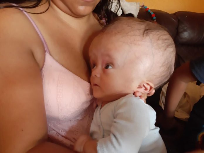 Elías bebé con hidrocefalia