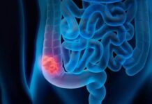 Incrementan en México los casos de cáncer colorrectal en jóvenes. Incrementa en México casos de cáncer colorrectal en jóvenes