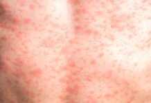 Secretaría de Salud confirmó primera muerte por sarampión en 2026.