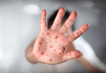 Confirman muerte de menor por complicaciones de sarampión en Tlaxcala.