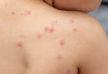 California alerta por aumento de casos de viruela del mono.